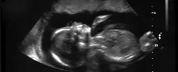 1 in 50 Million Chance: US Woman With Rare Double Uterus Is Pregnant in Both