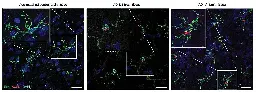 Root cause of Alzheimer's may be fat buildup in brain cells, research suggests