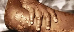 Profiteering lets Mpox epidemic spread out of control | Climate &amp; Capitalism